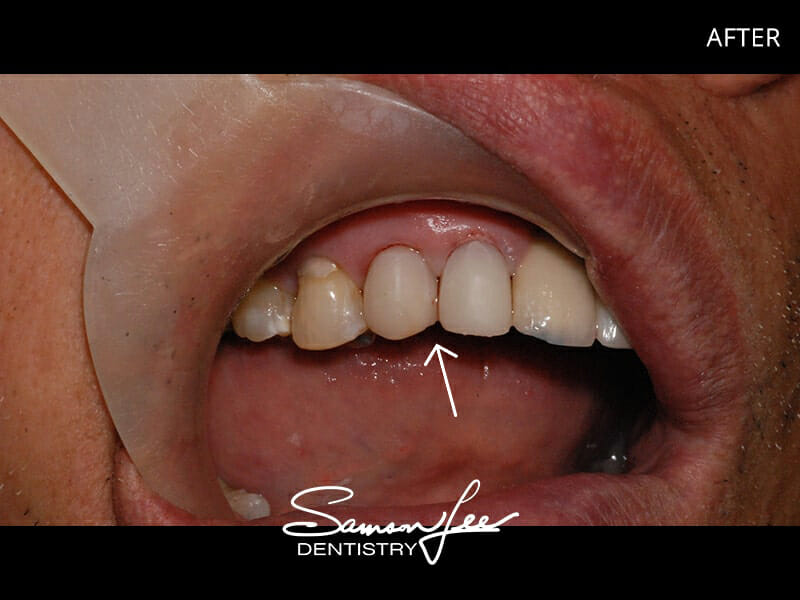 After dental bonding smile