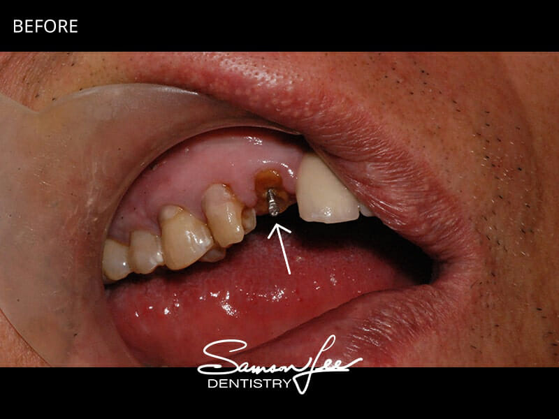Before dental bonding smile