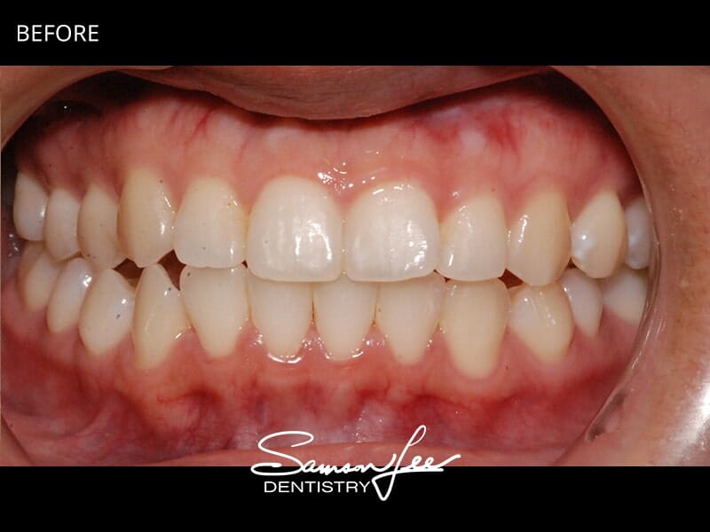 Before bonding imperfect teeth