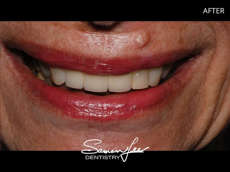 After smile makeover