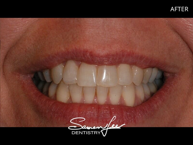 After Invisalign treatment
