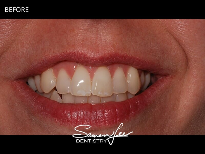 Before Invisalign treatment