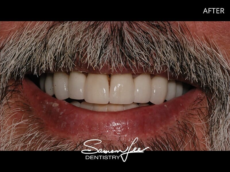 After smile makeover side view