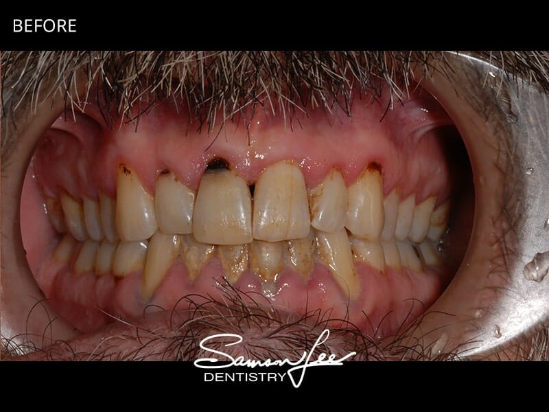 Before smile makeover side view