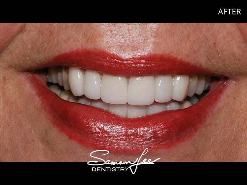 After smile makeover bright smile