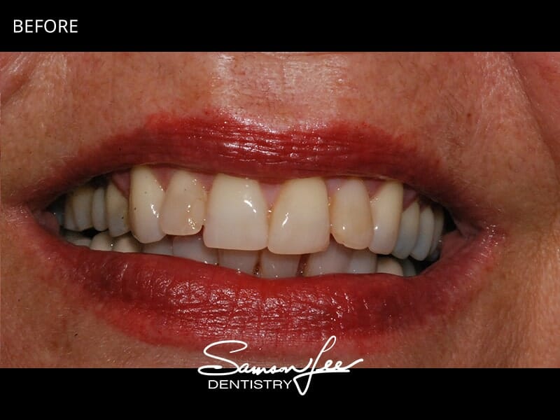 Before smile makeover dull smile