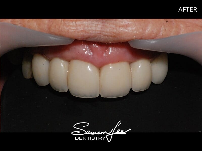 After smile makeover teeth focus