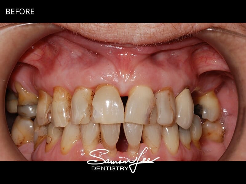 Before smile makeover teeth focus