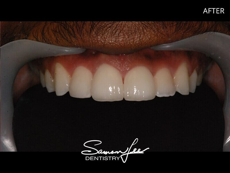 After Invisalign and bonding