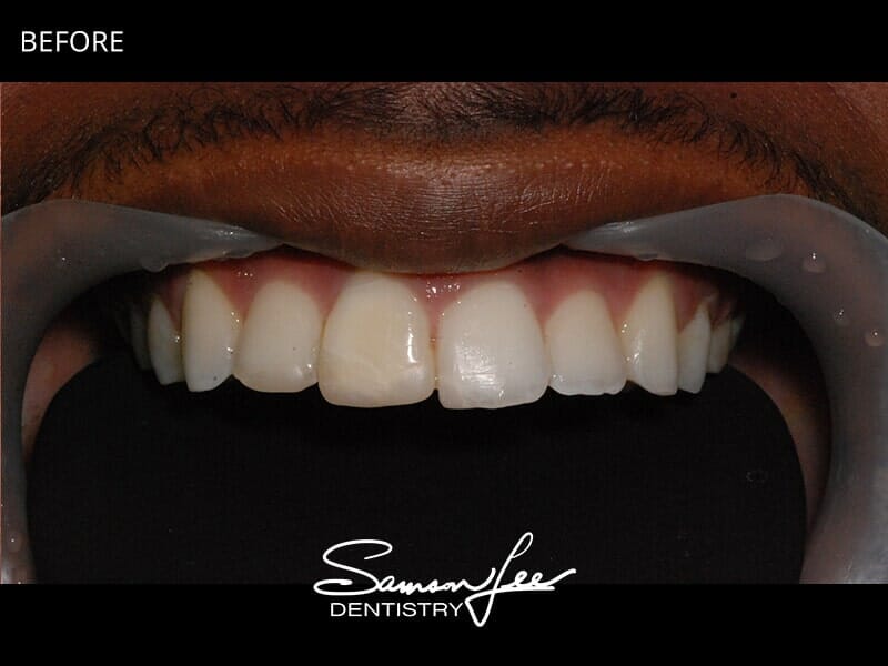 Before Invisalign and bonding