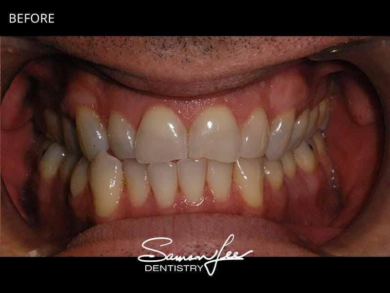 Before Invisalign close-up
