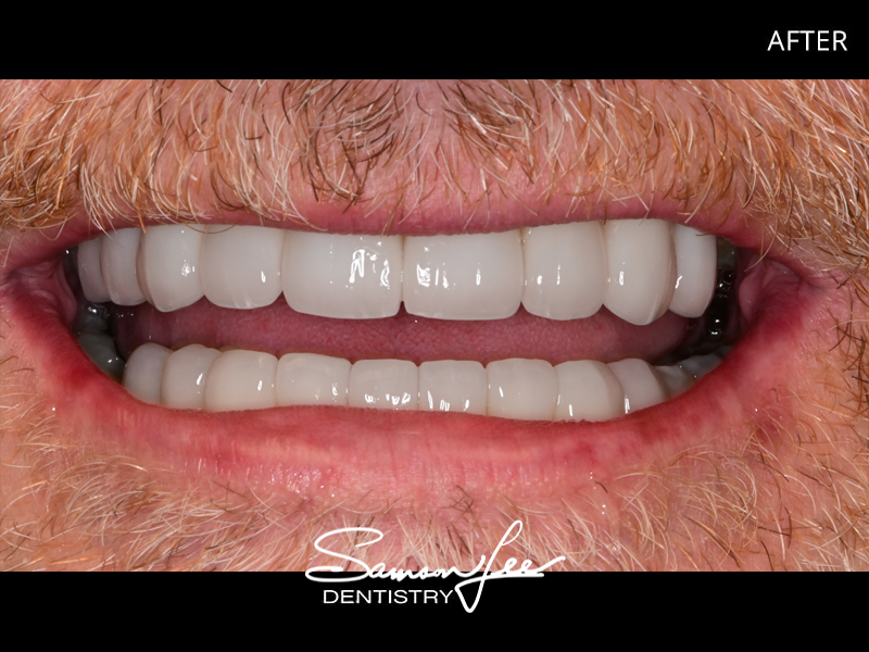 After smile makeover close-up