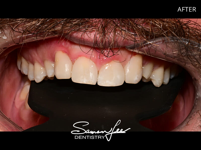 After dental treatment smile 2