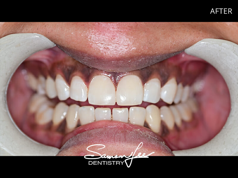 After dental treatment smile 1