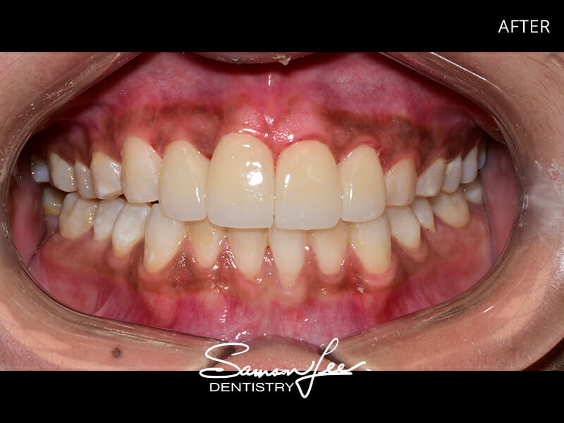 After veneers treatment