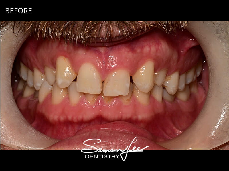 Before dental treatment smile 2