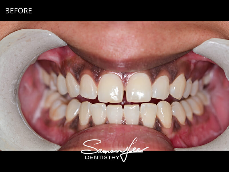 Before dental treatment smile 1