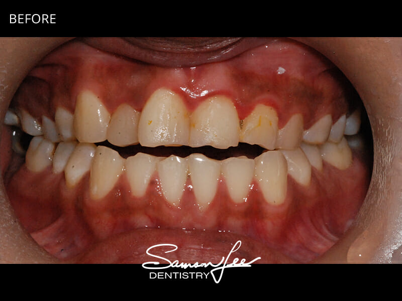 Before veneers treatment