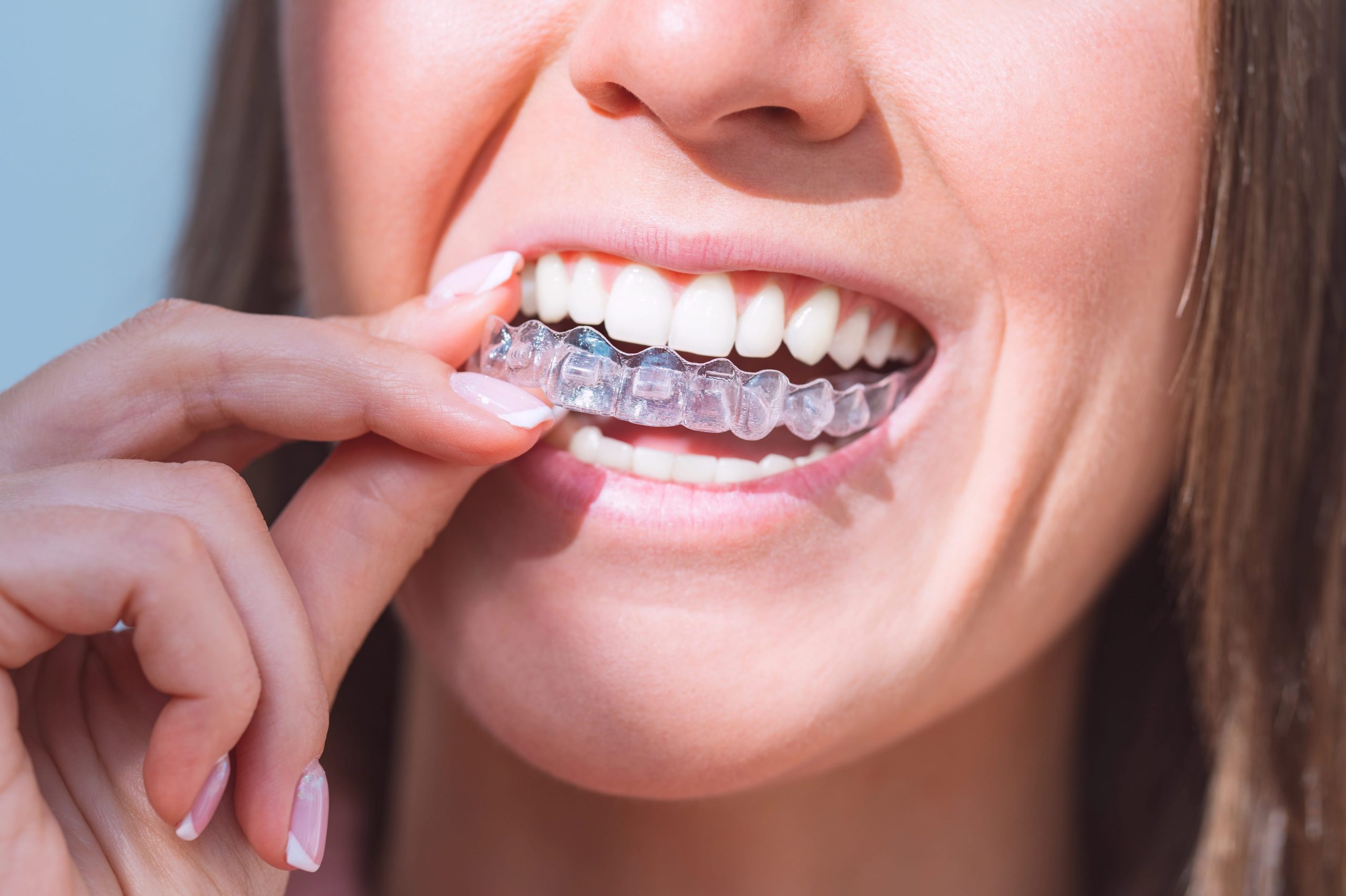 Patients Choosing Invisalign And Clear Aligners Near Mississauga