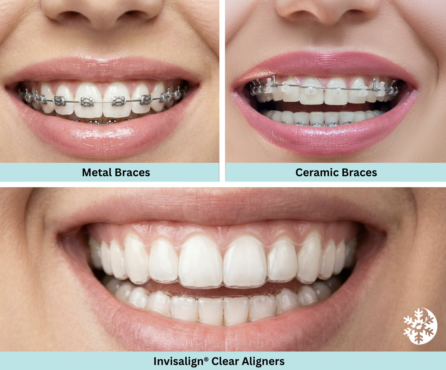 Orthodontic Treatment Options Mississauga Clear Aligners And Braces